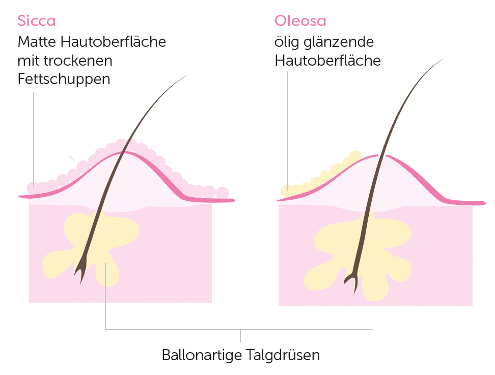 Unreine-Haut-Die-Lösung-Kruse-Medical-Beauty-Langenfeld